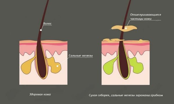 Нарушение работы сальных желез кожи
