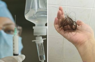 выпадают волосы после наркоза что делать